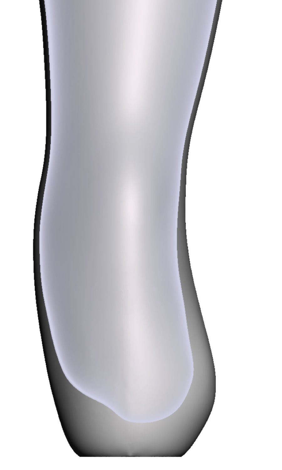 Exostosis — 3D Model