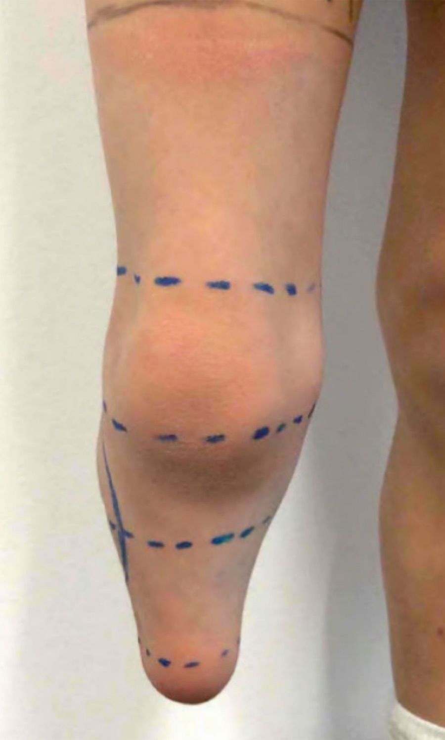 Pediatrics / XXS — Limb