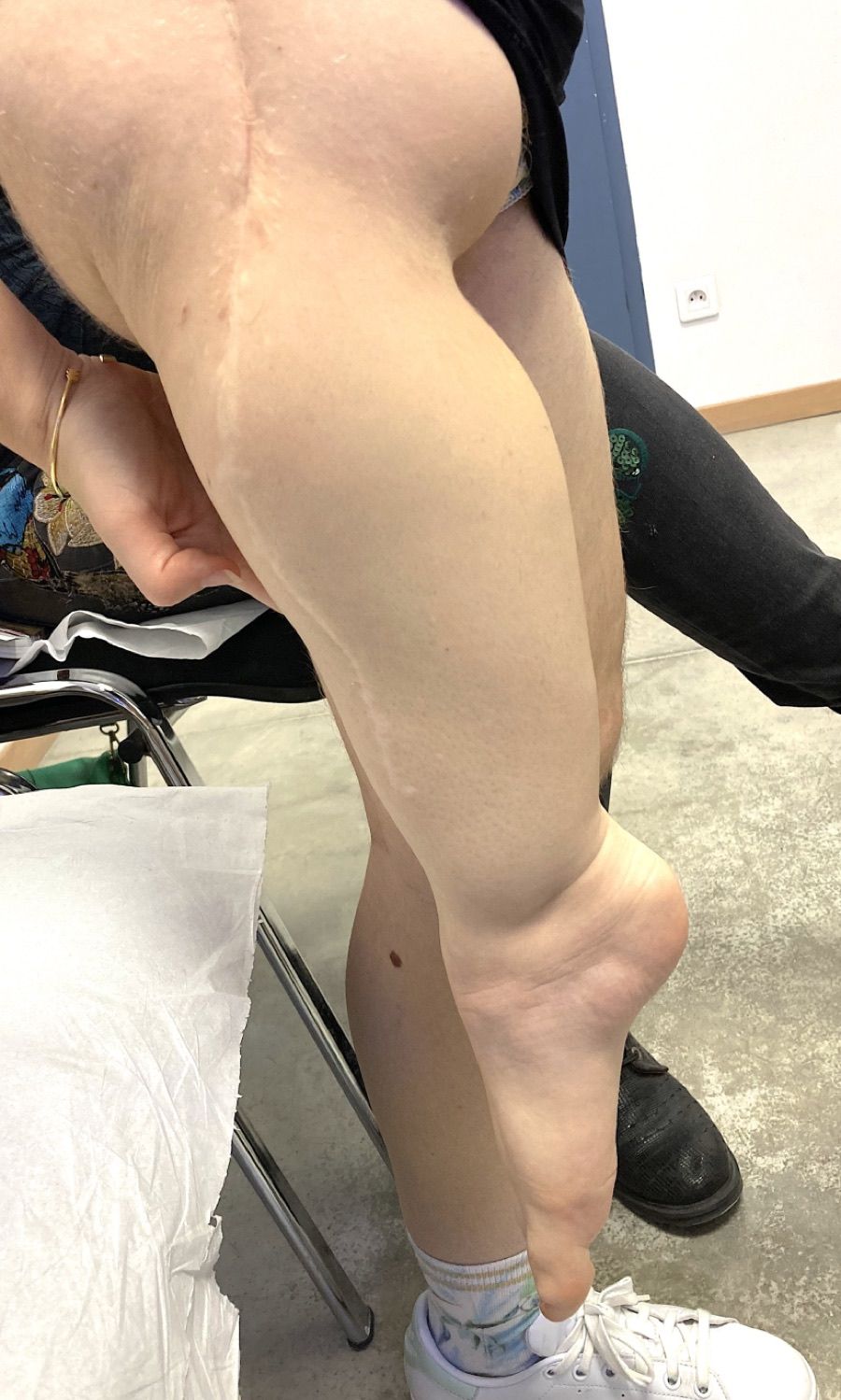 Rotationplasty — Limb