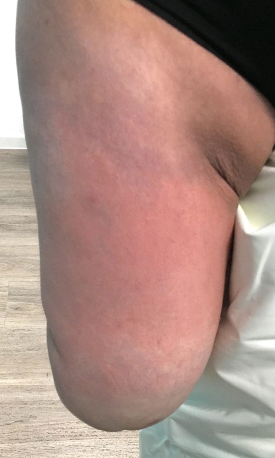 Sensitive Adductor — Limb