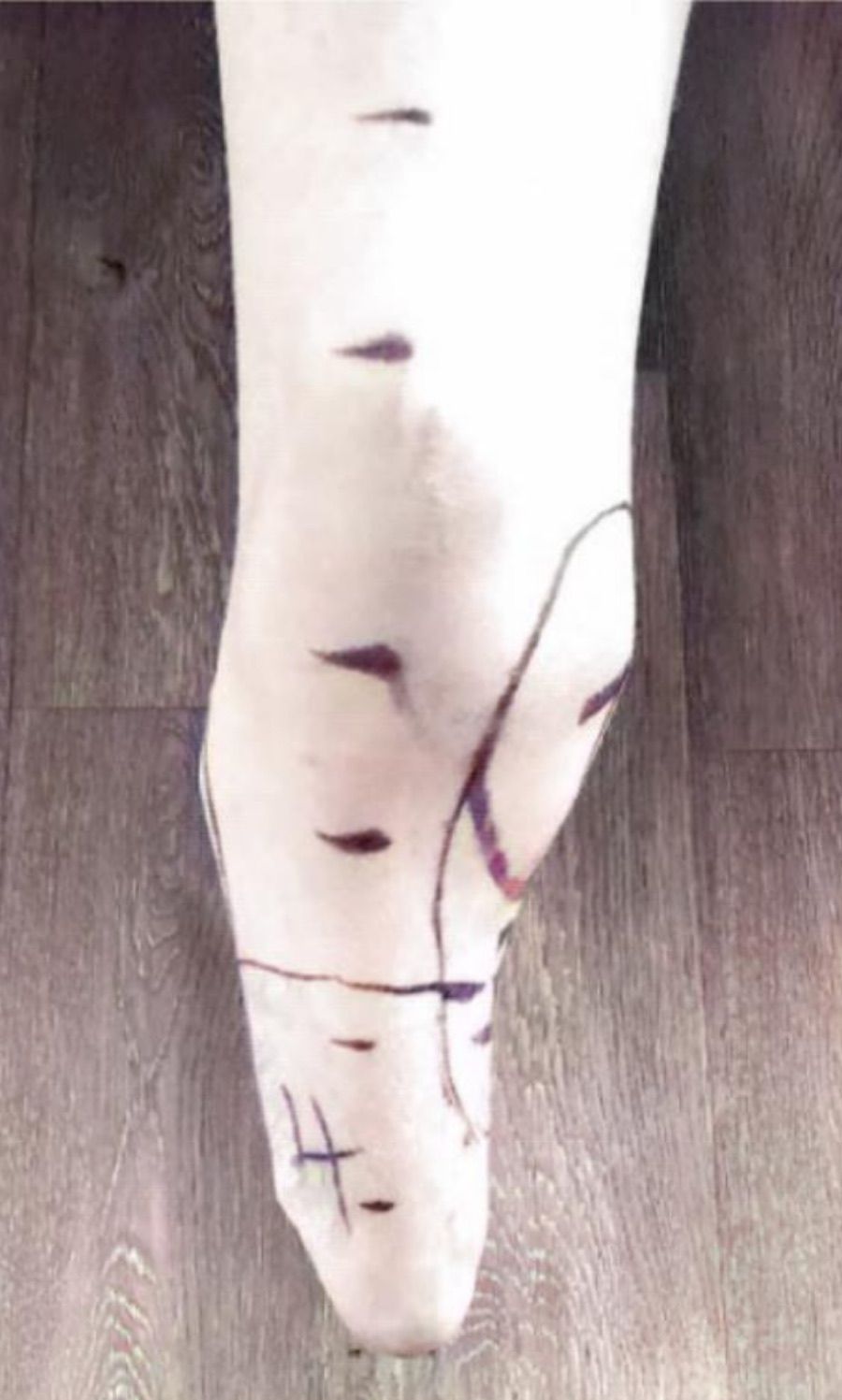 Prominent Condyle — Limb