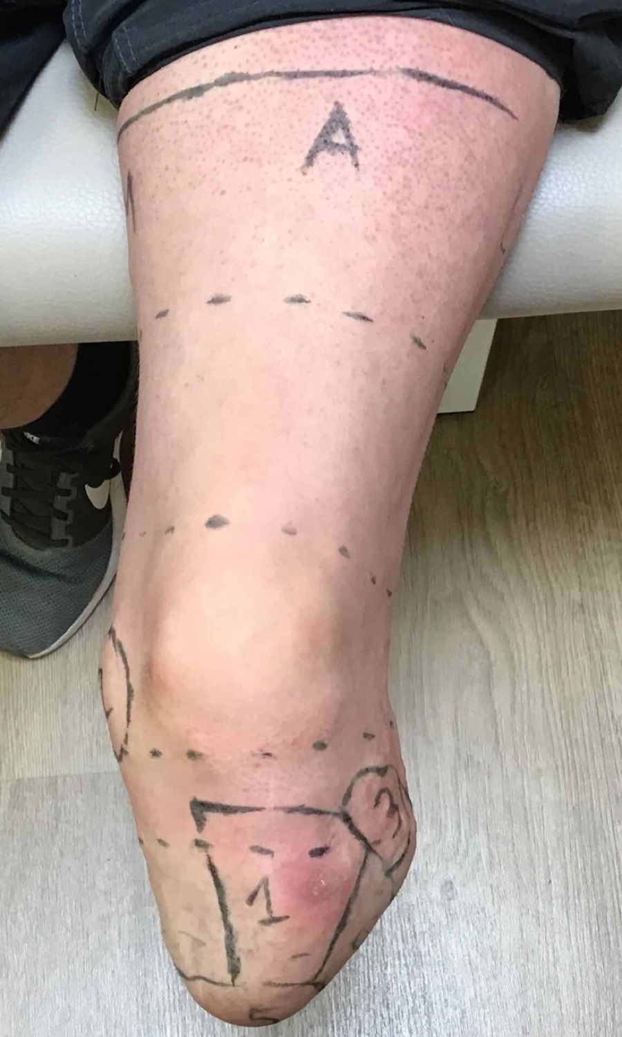 Prominent Fibula — Limb